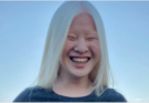 Girl Abandoned By Parents For Her Looks Wants To Prove The World Wrong – Now She Models For Vogue